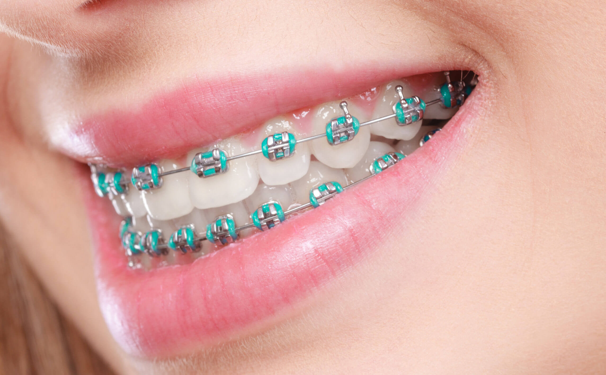 braces treatment in Multan