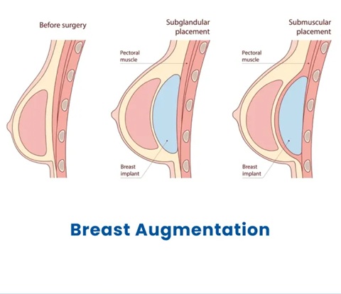 breast augmentation in Multan