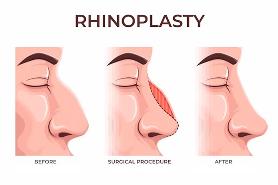 Rhinoplasty