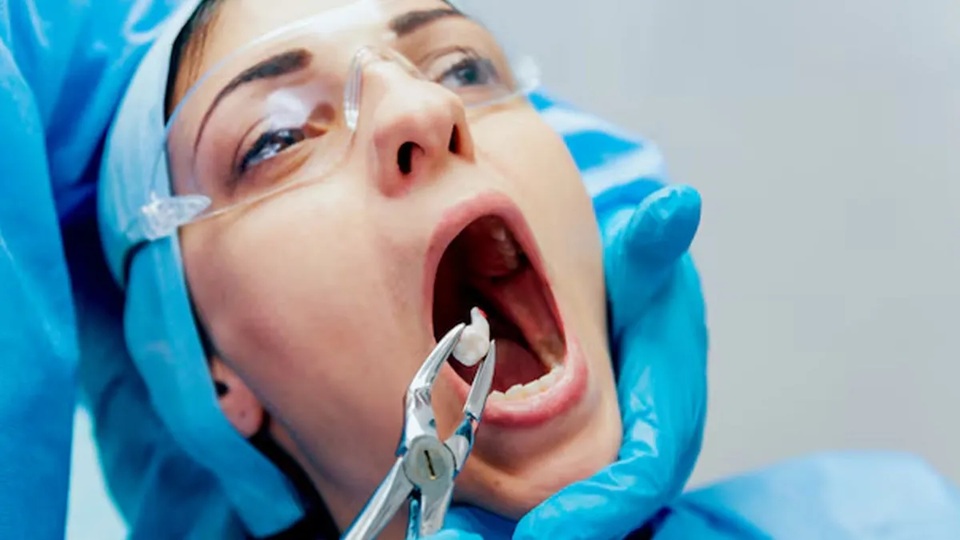 Tooth Extraction