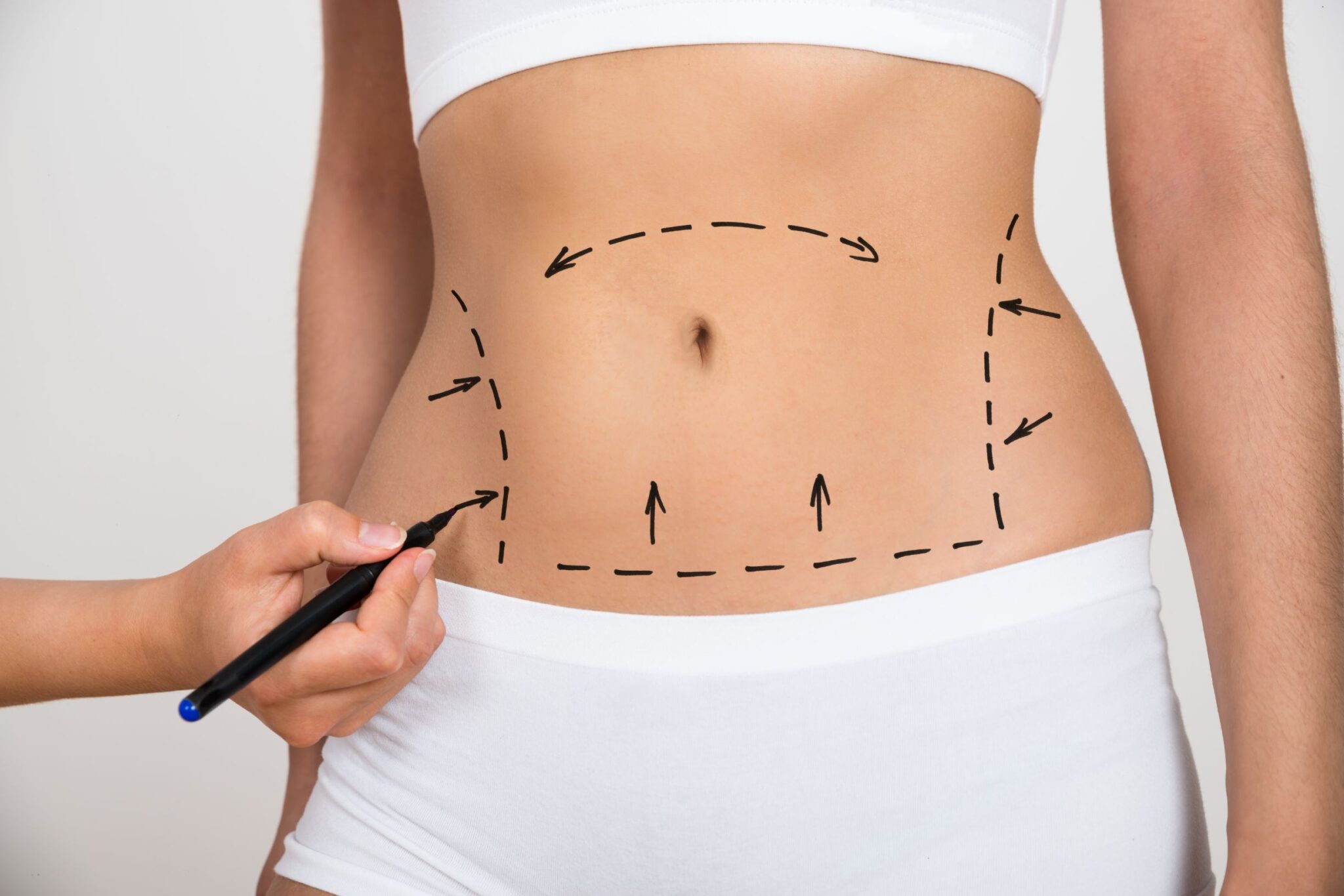 liposuction 1