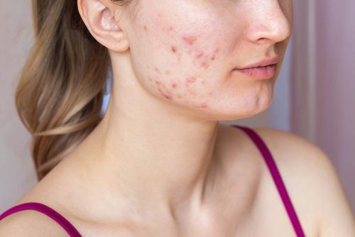 acne & scars treatment in Multan