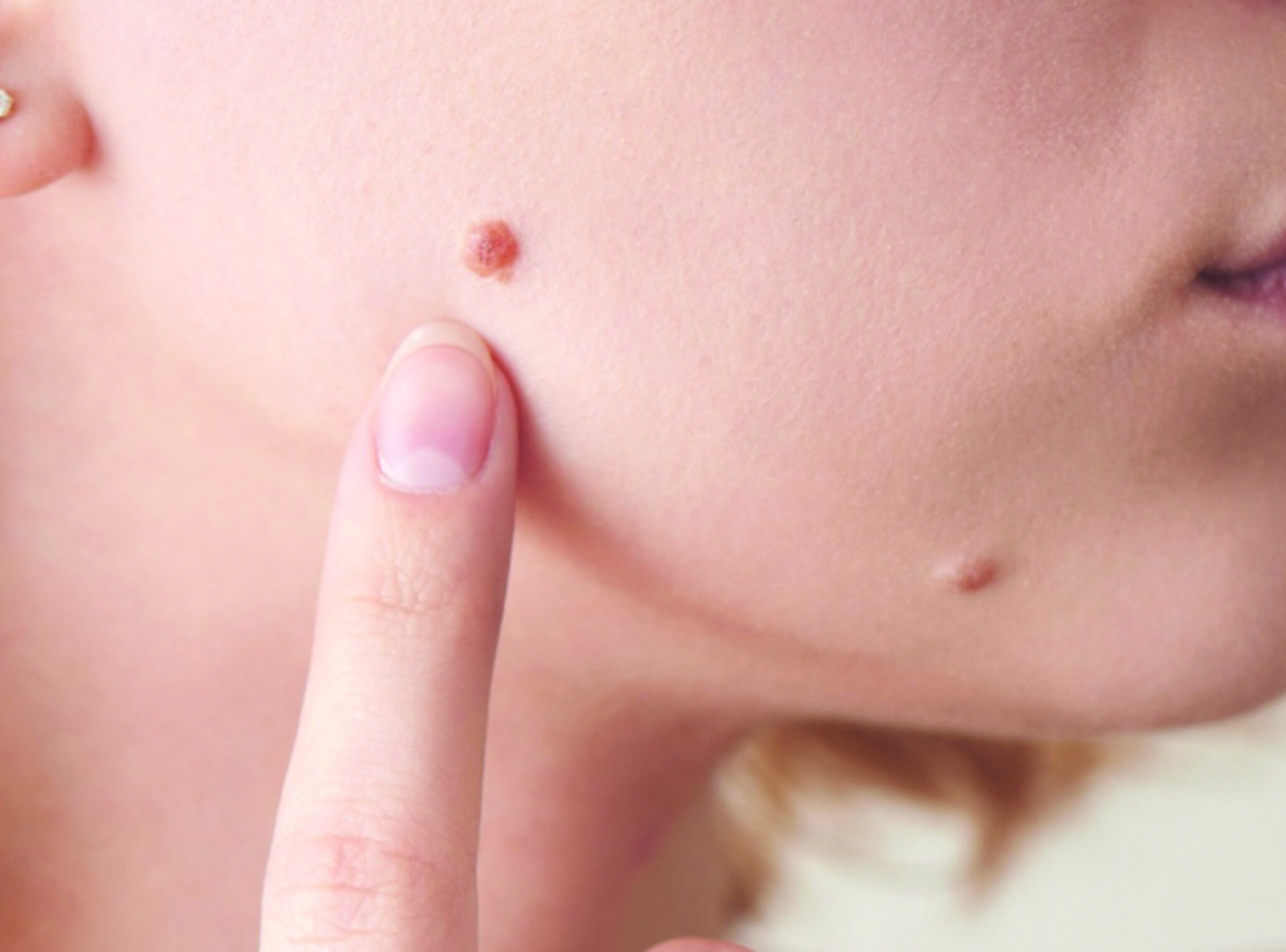 mole removal in multan glam aesthetics