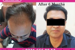 Hair Transplant